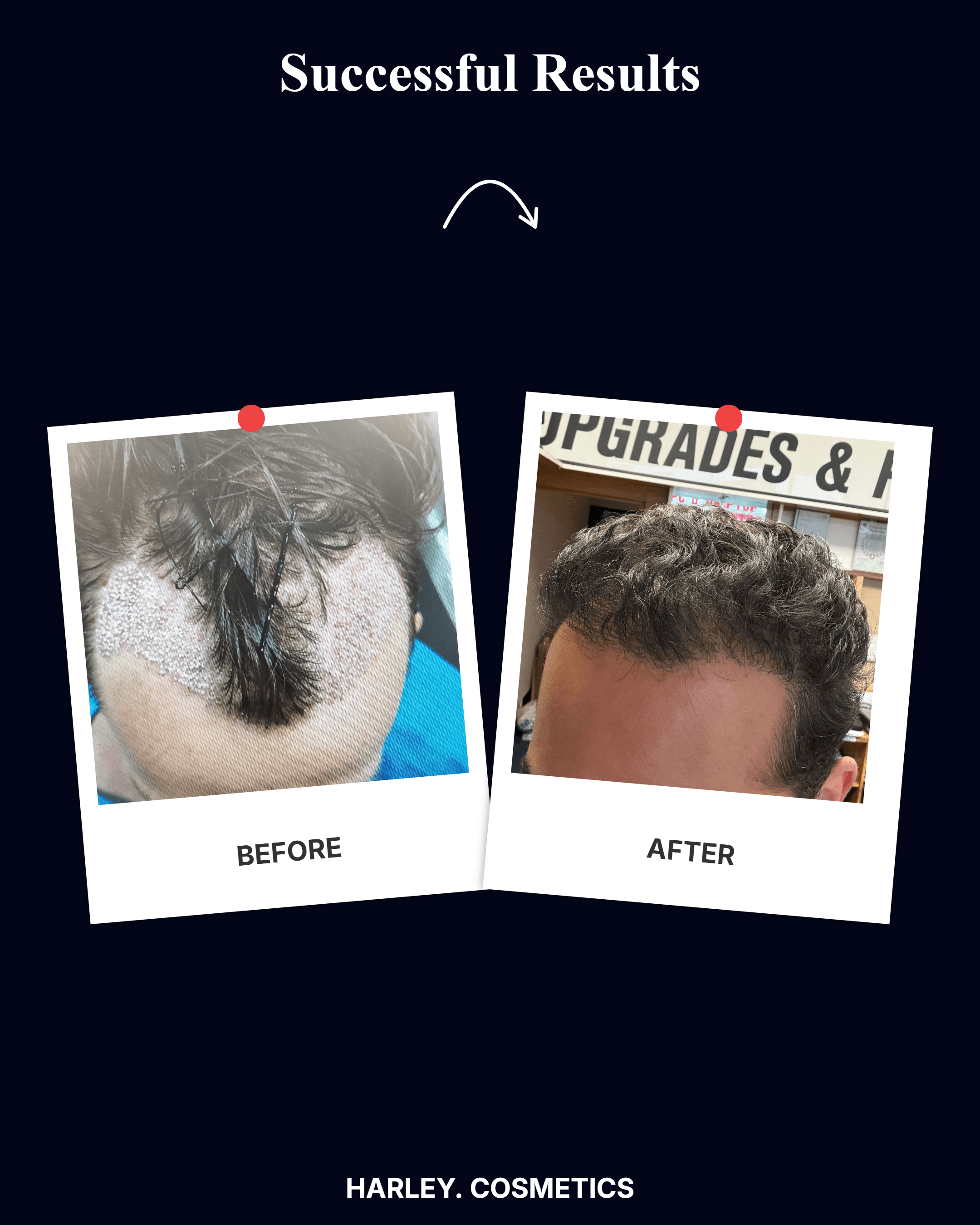 Hair Transplant Result 1
