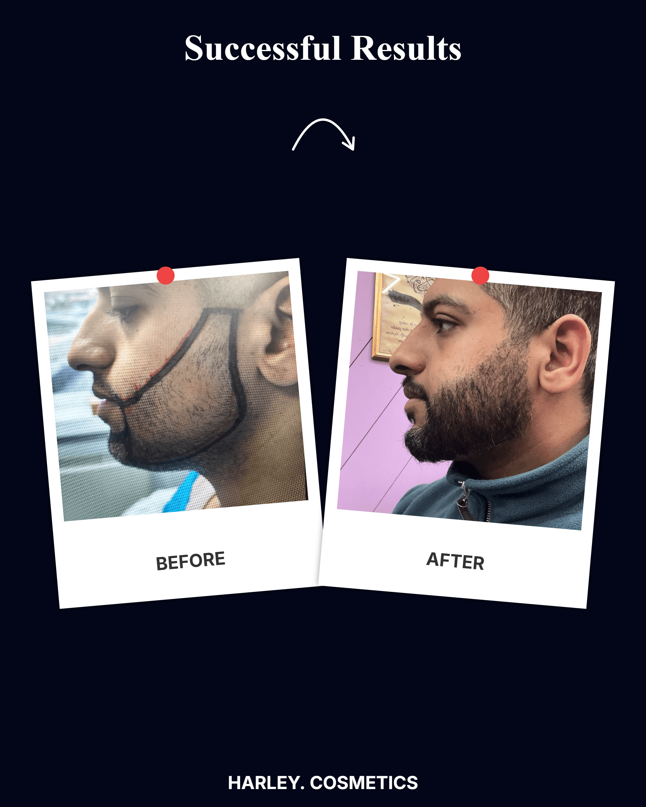 Hair Transplant Result 1