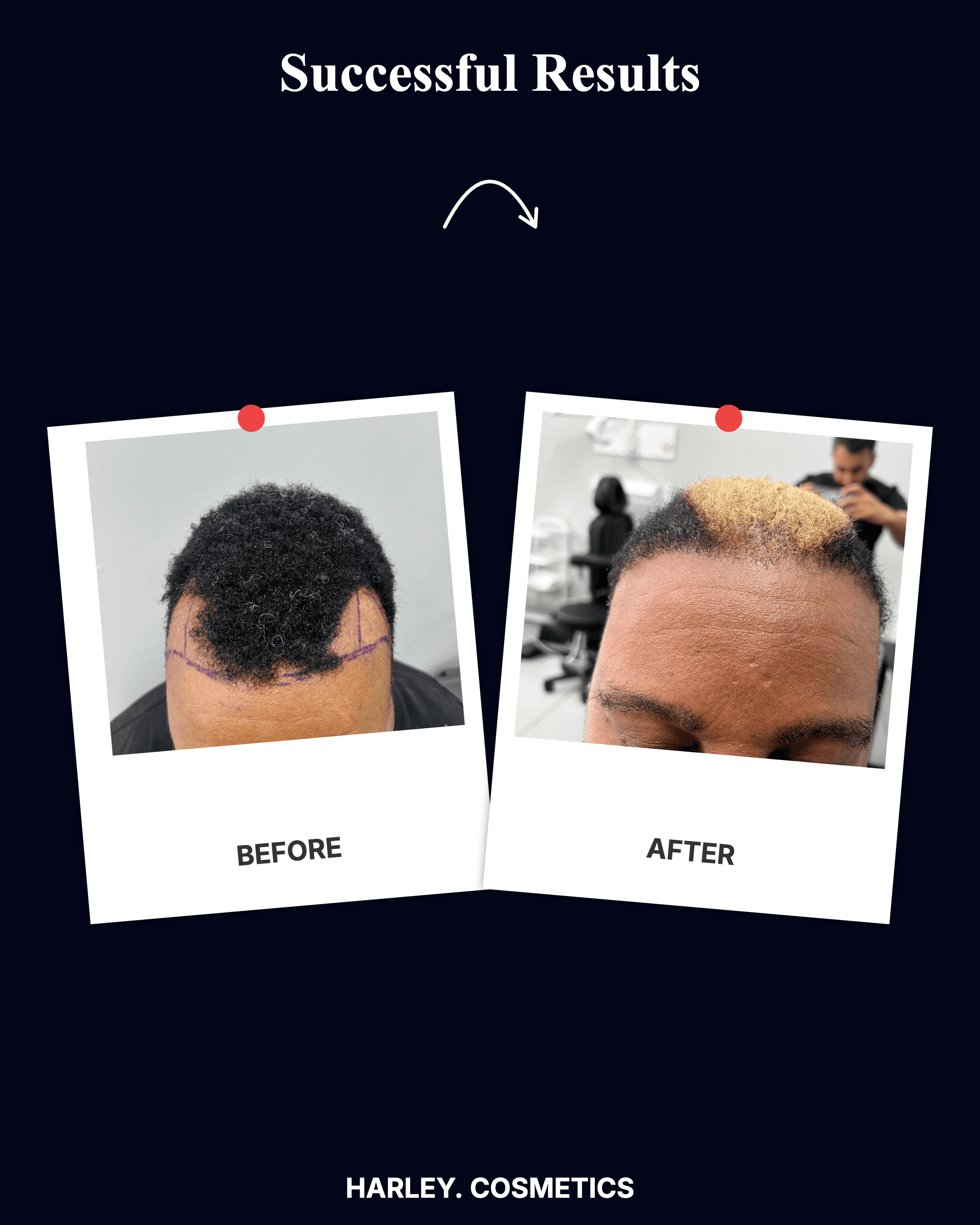 Hair Transplant Result 1