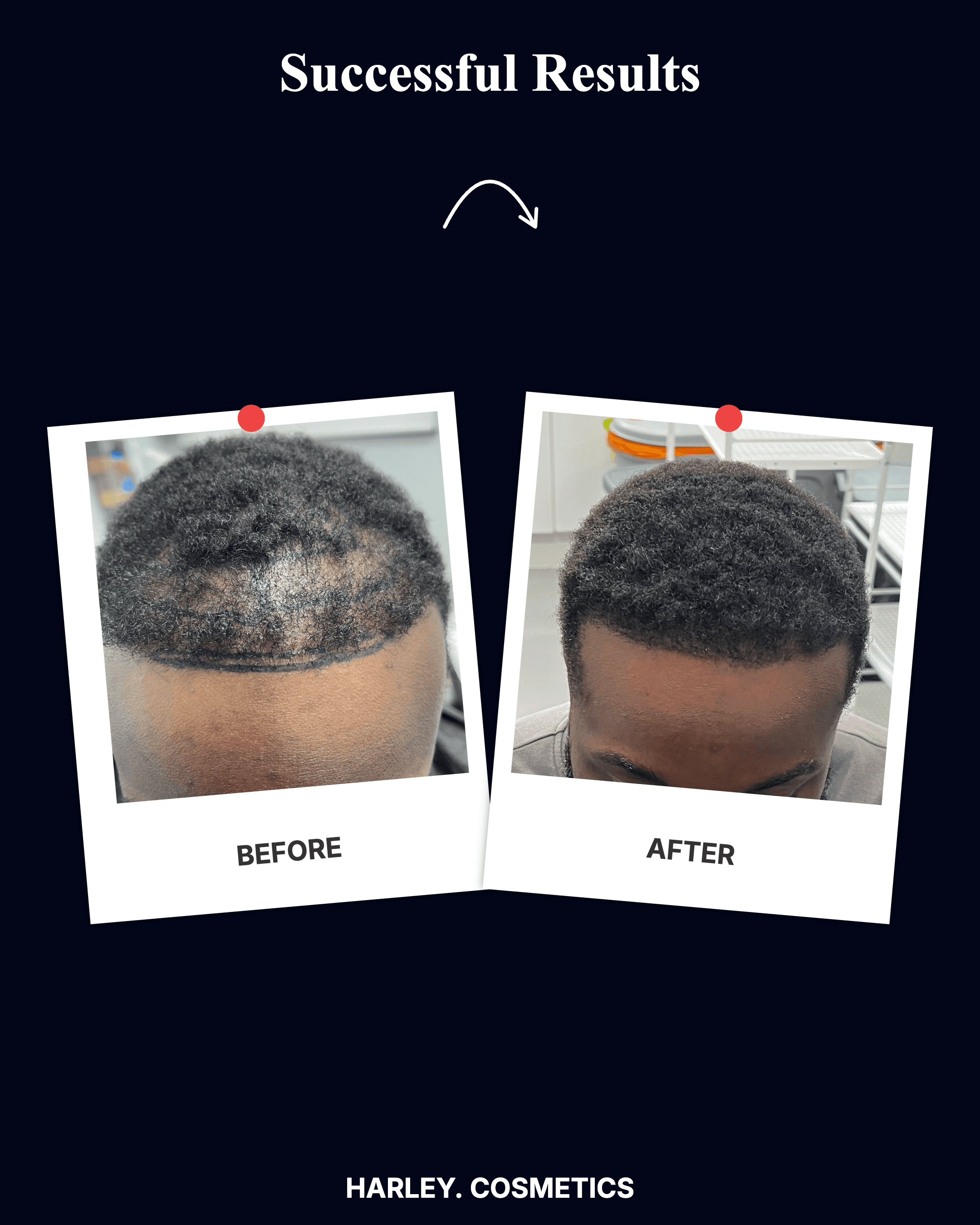 Hair Transplant Result 2