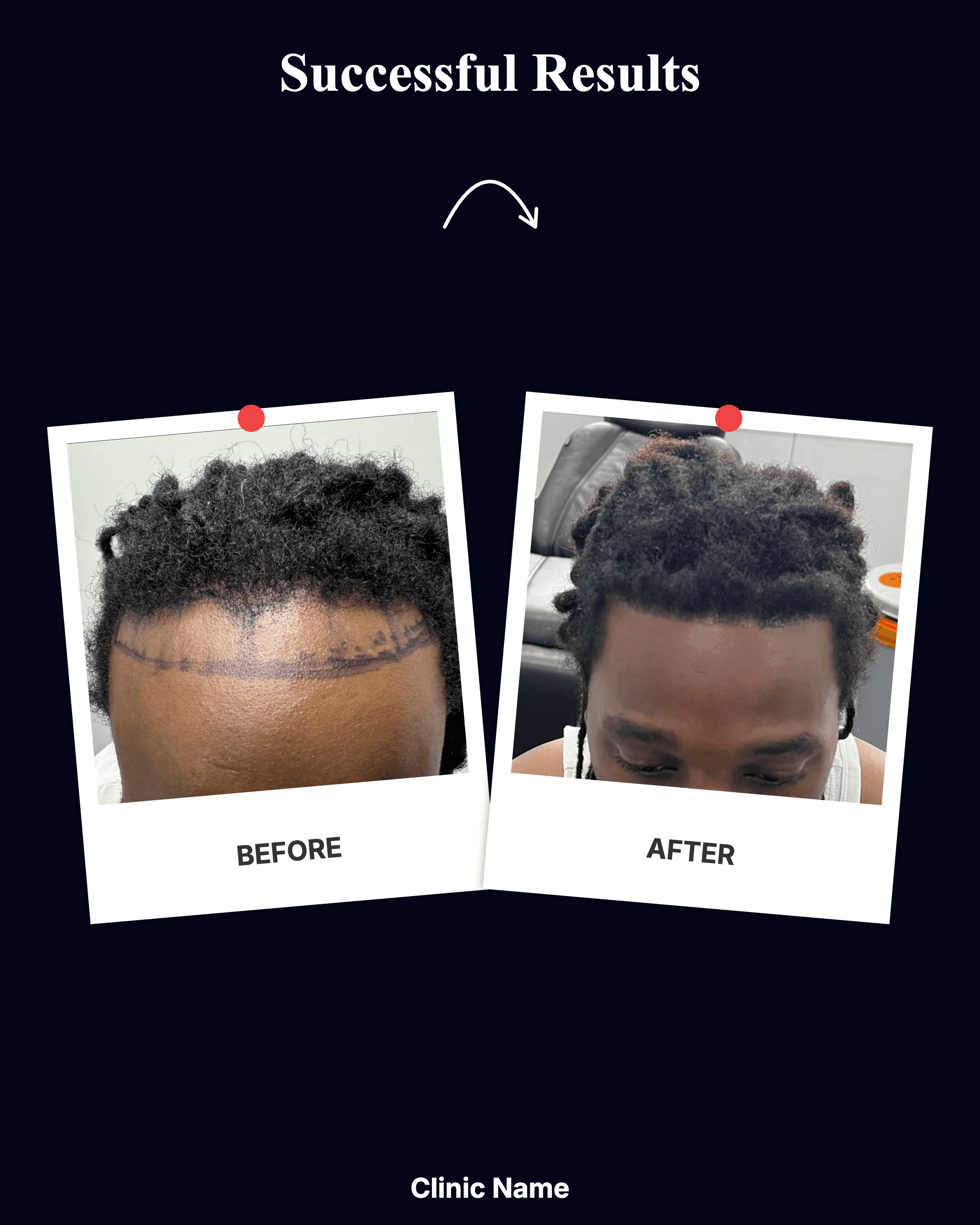 Hair Transplant Result 3
