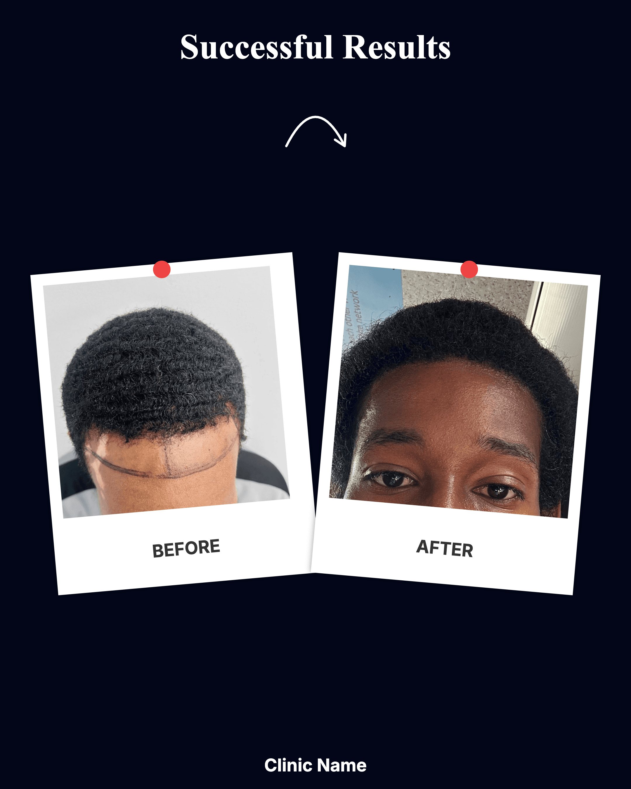 Hair Transplant Result 4