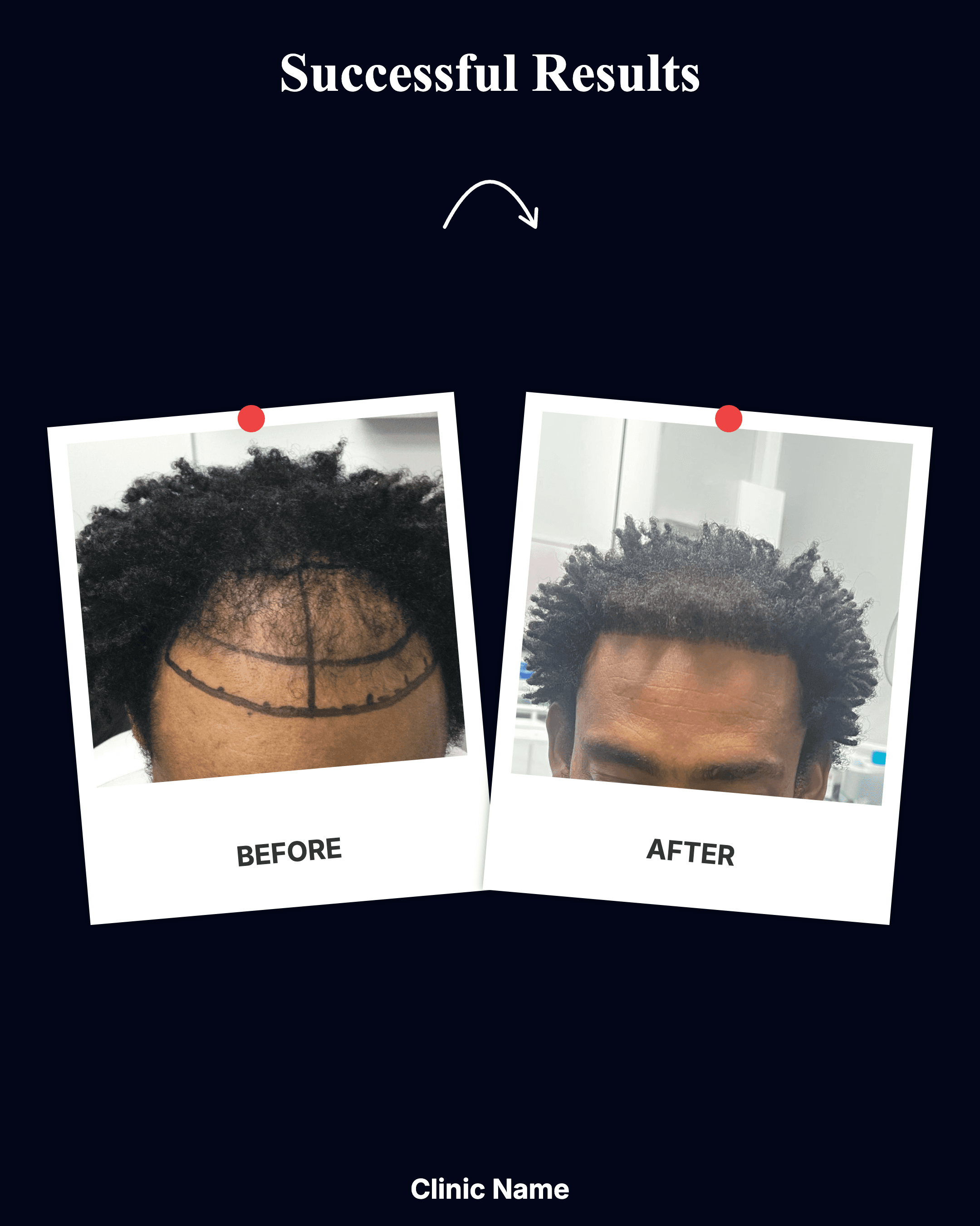 Hair Transplant Result 5
