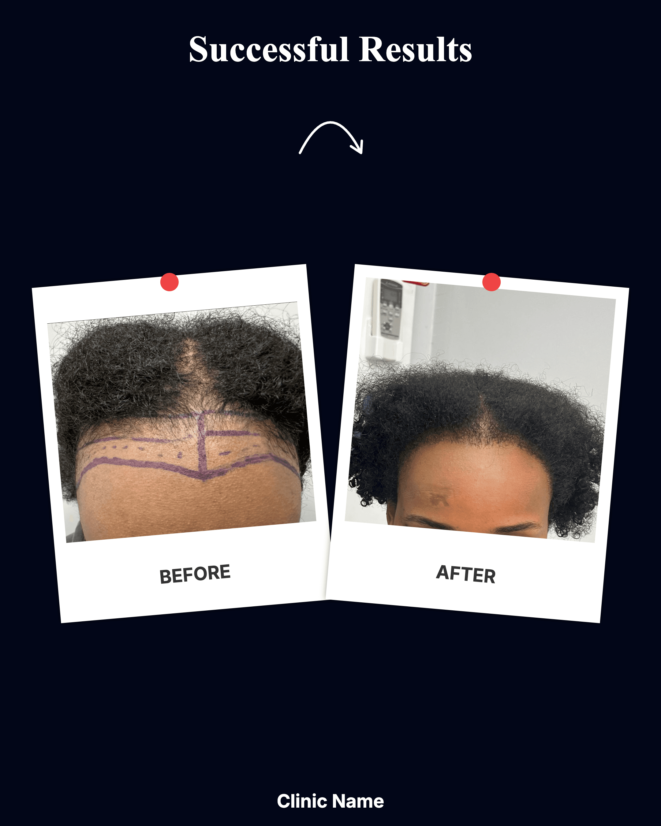 Hair Transplant Result 6