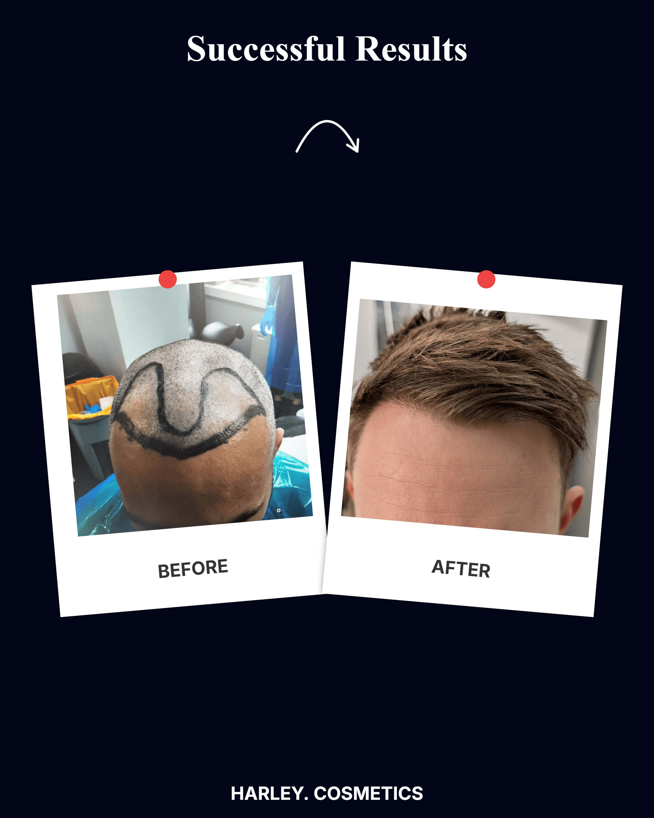 Hair Transplant Result 2
