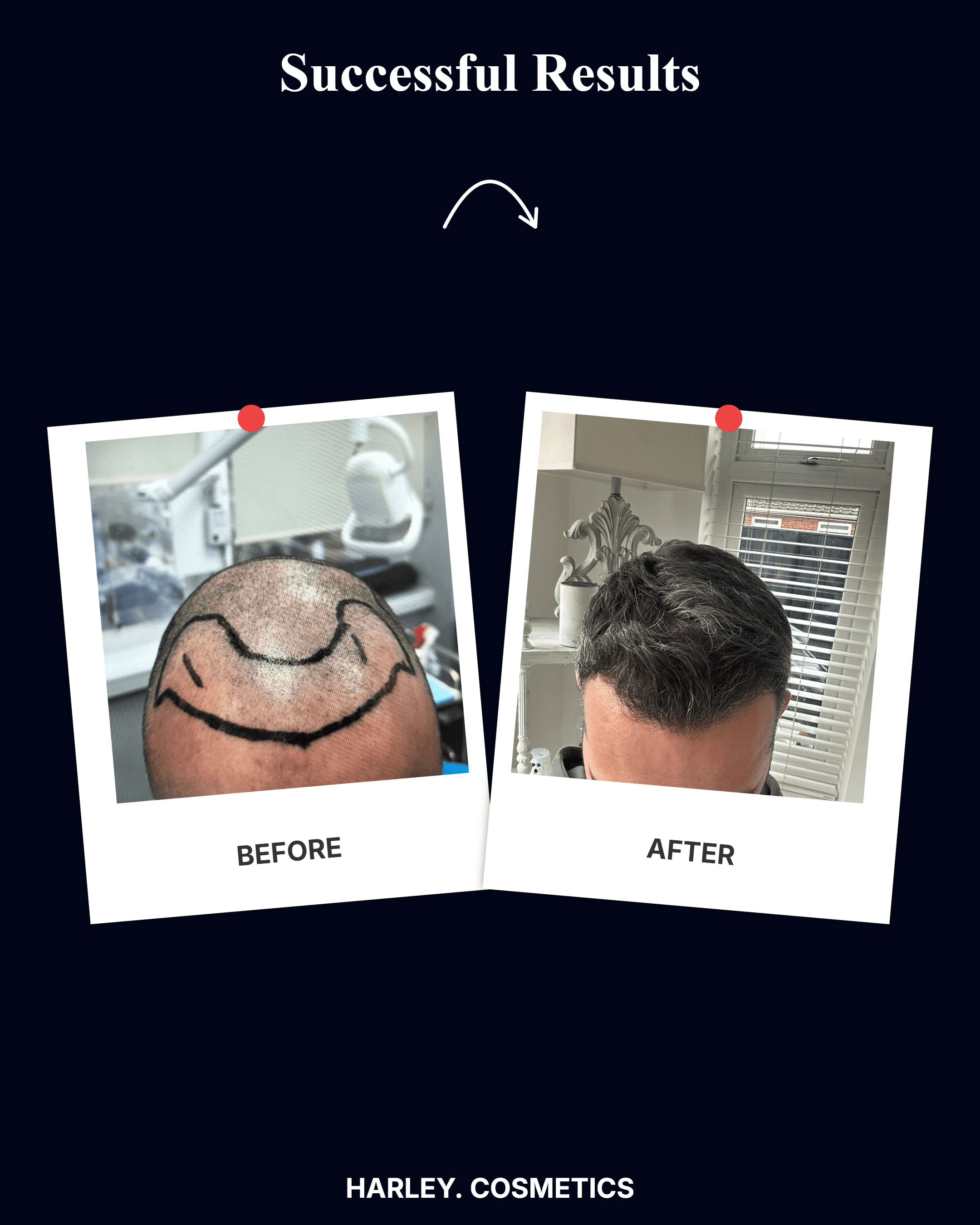 Hair Transplant Result 3