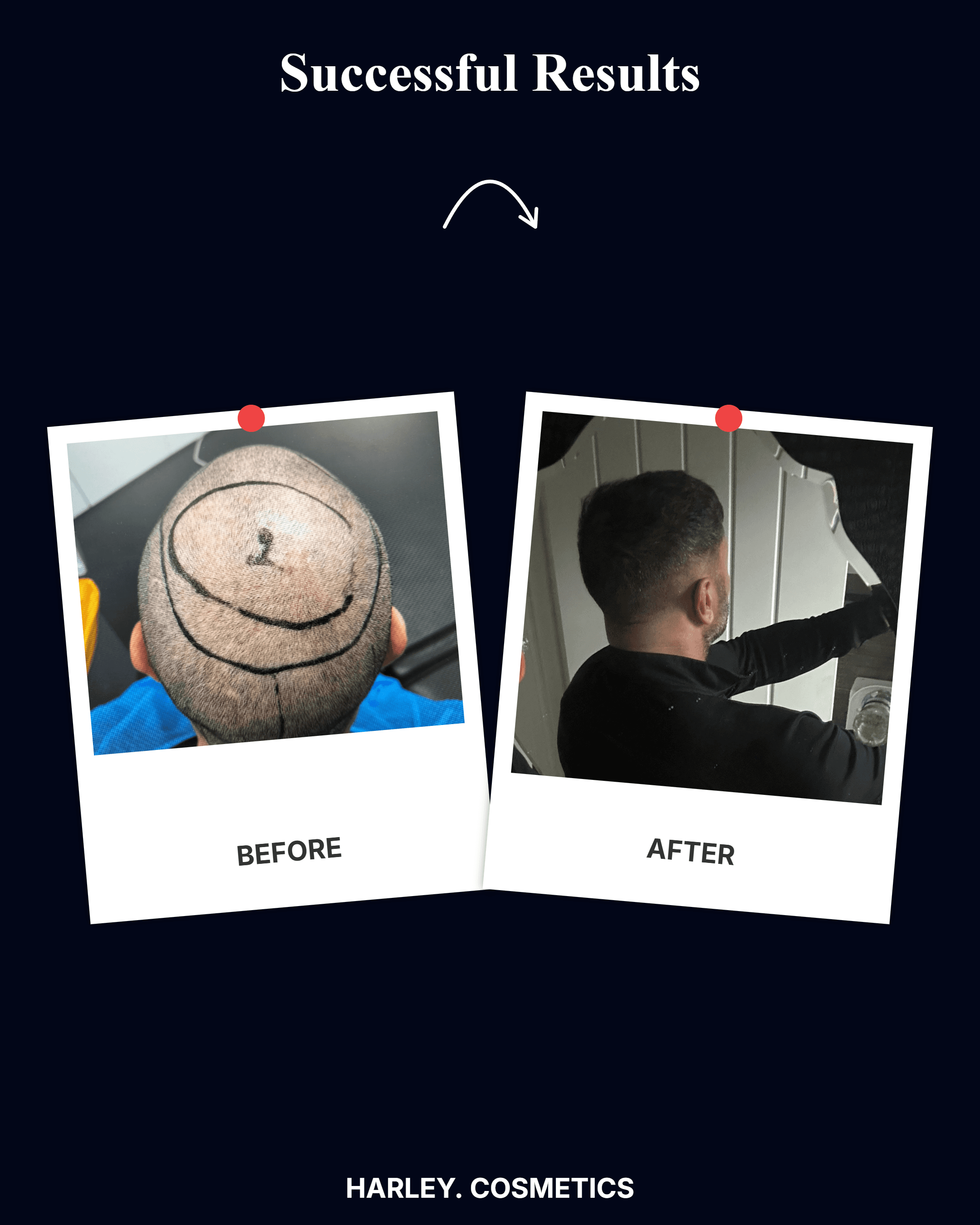 Hair Transplant Result 4