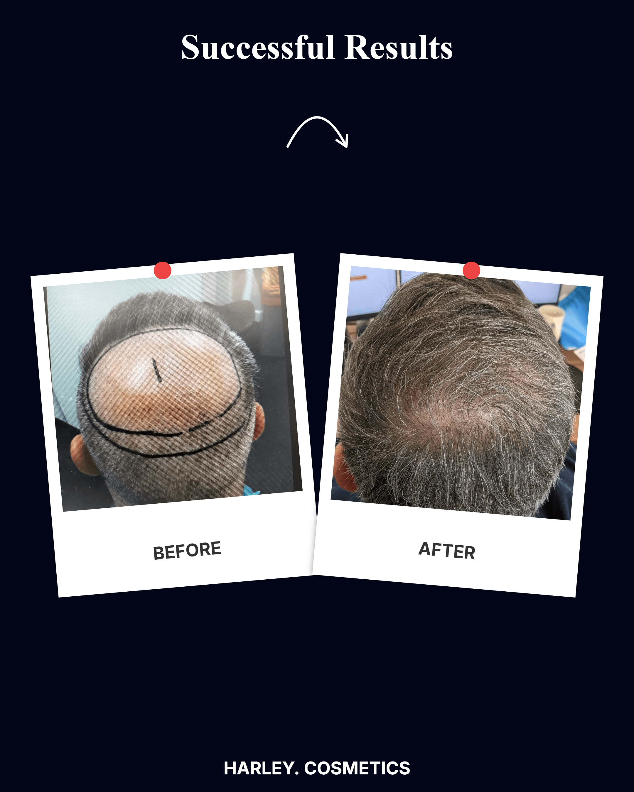 Hair Transplant Result 5