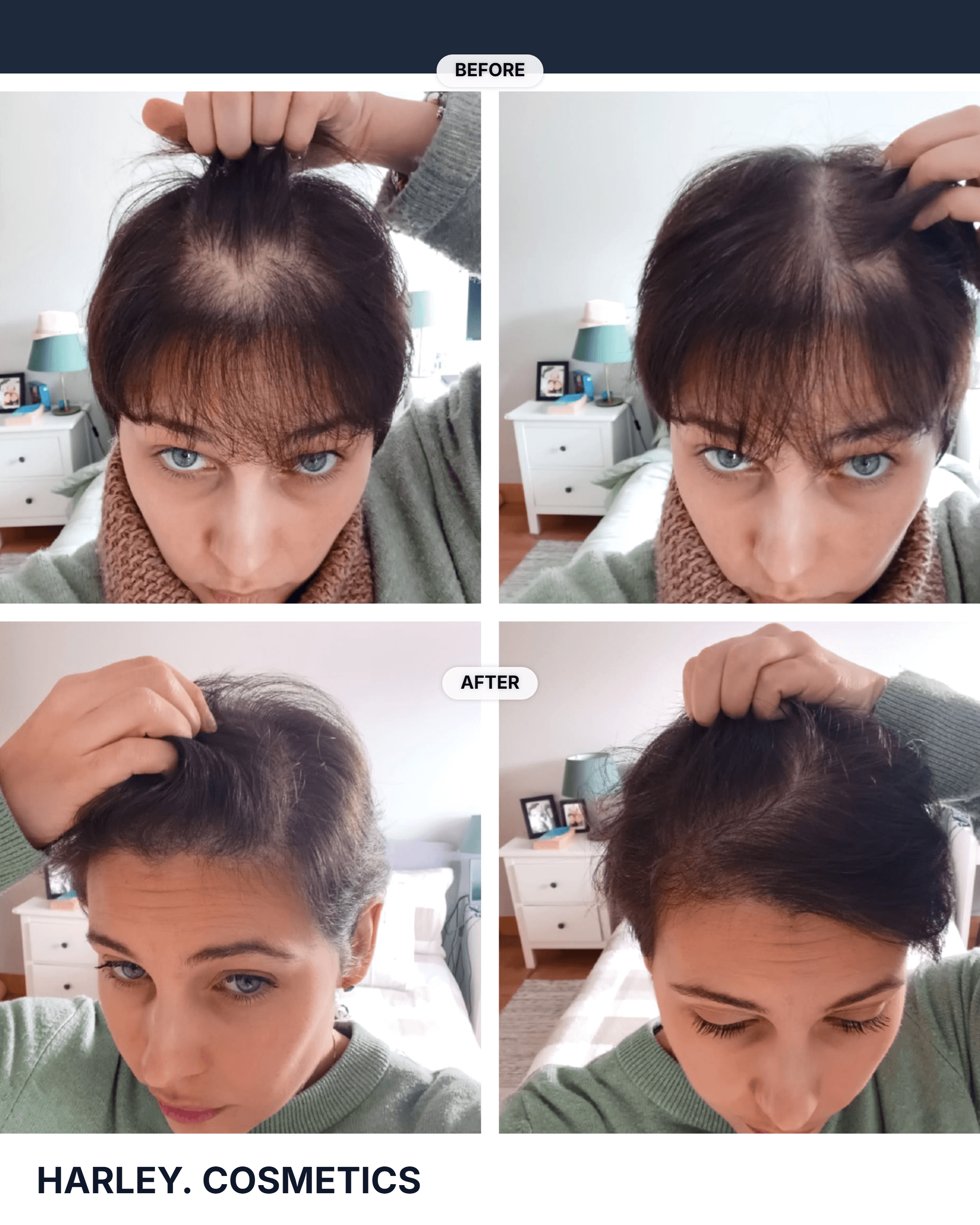 Hair Transplant Result 1