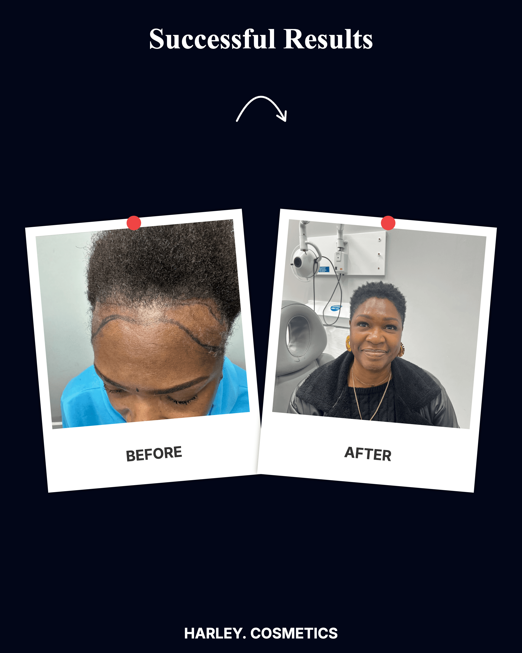 Hair Transplant Result 2