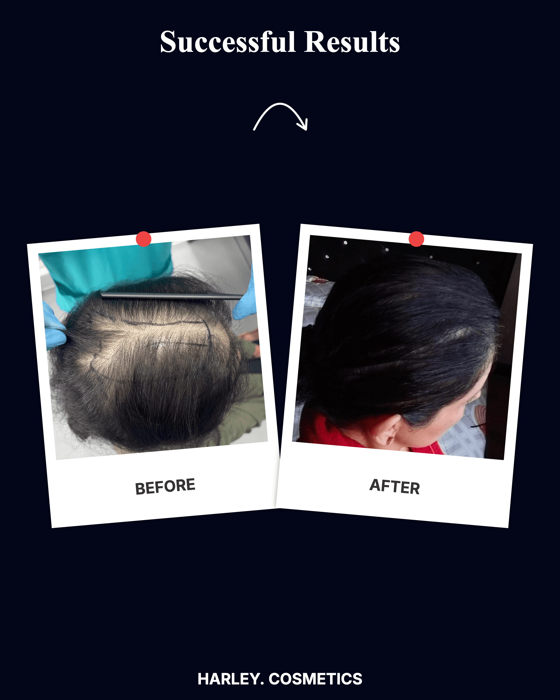 Hair Transplant Result 3