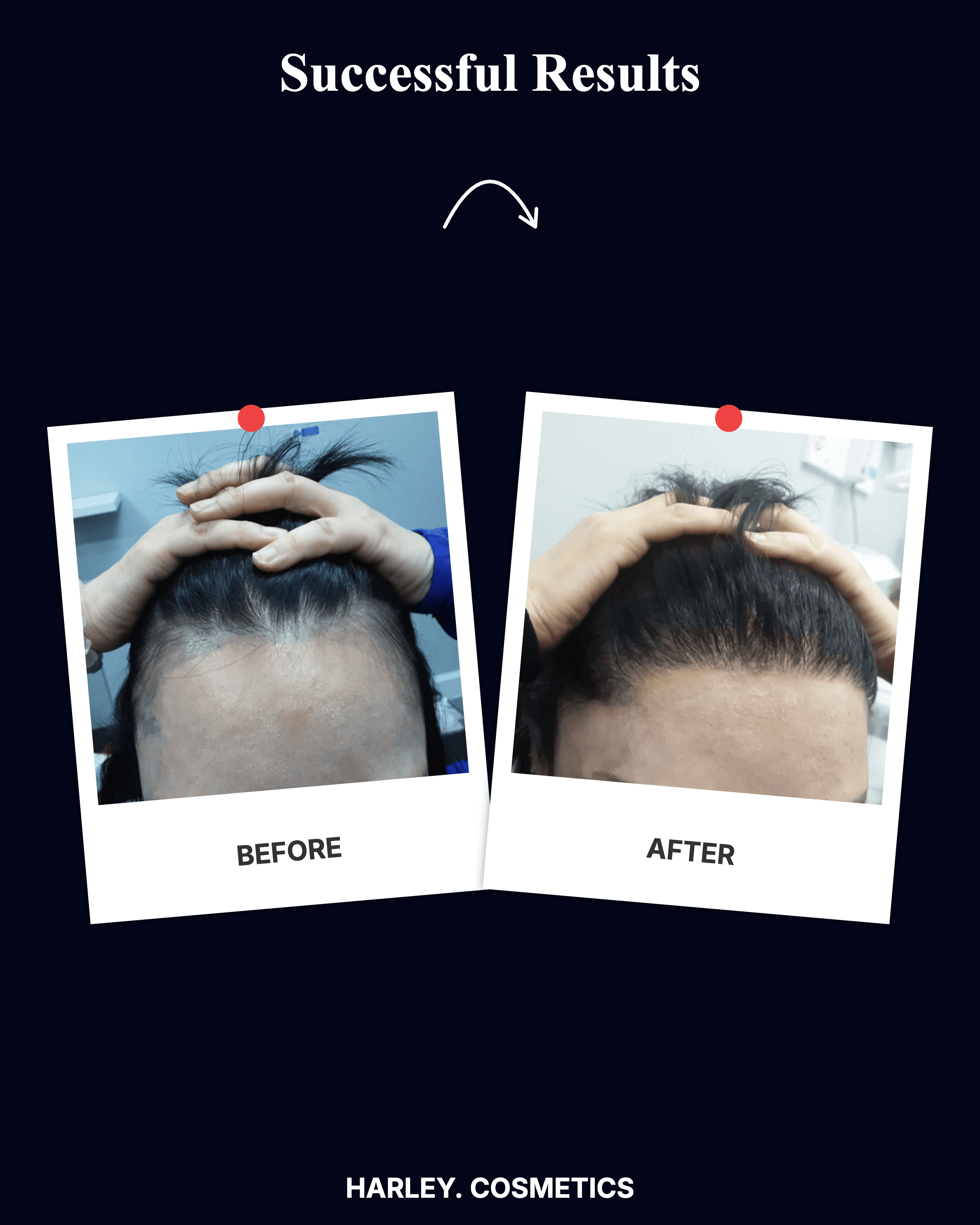Hair Transplant Result 4