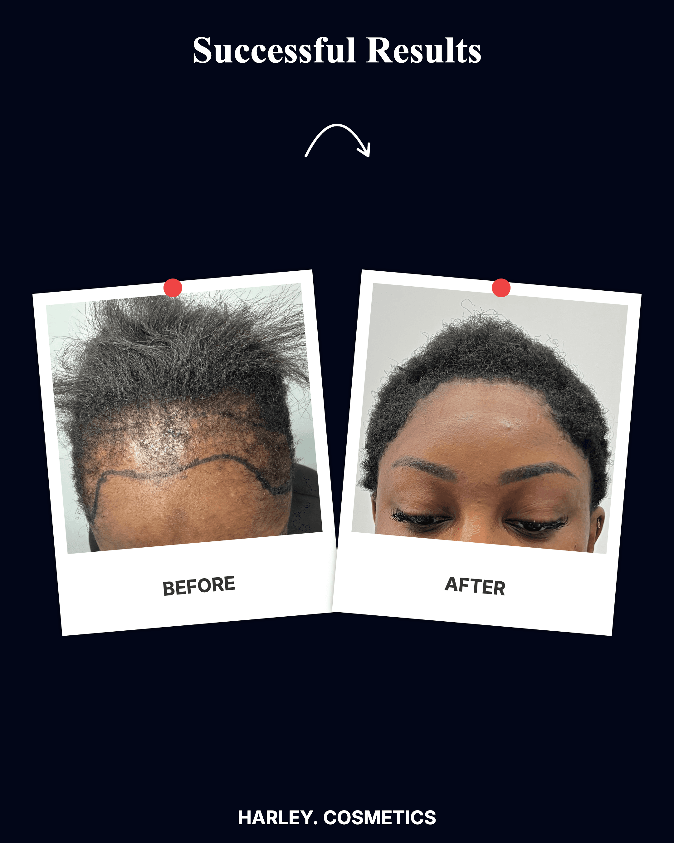 Hair Transplant Result 5